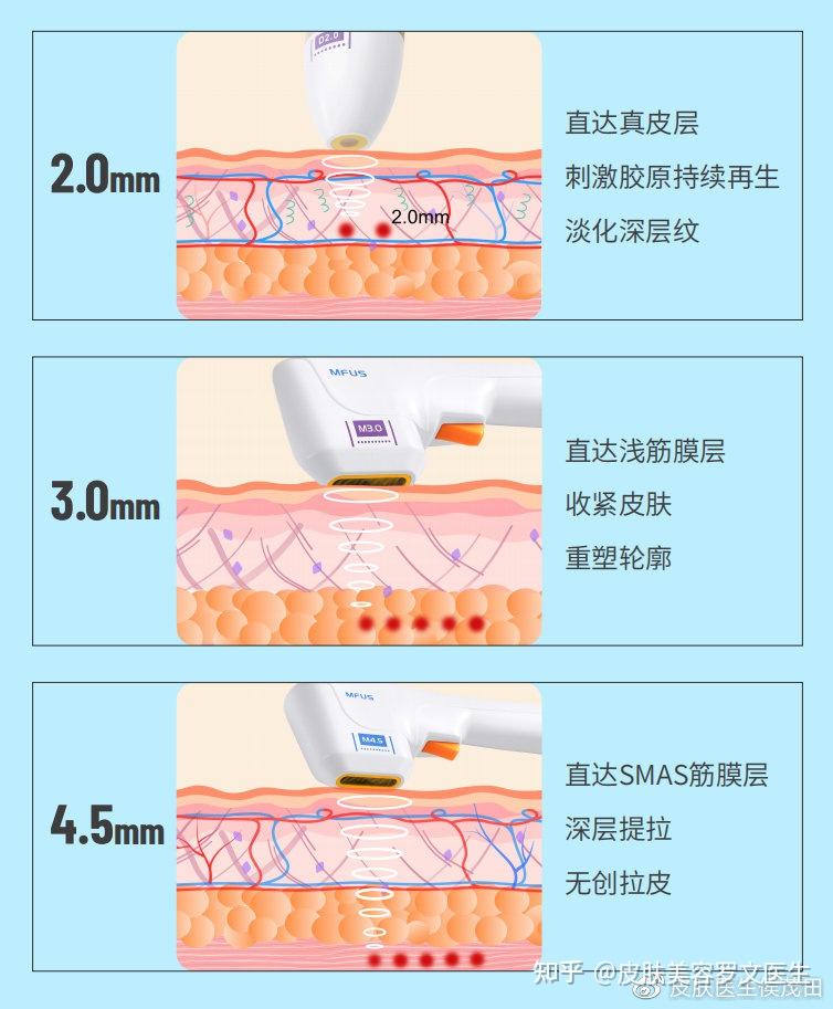 半島超聲炮vs熱瑪吉vs歐洲之星fotona4dpro應該怎麼選71有啥不同