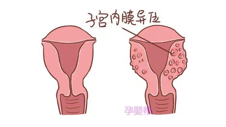 4,子宫内膜异位症有的子宫内膜异位生长在子宫颈,呈蓝紫色结节状