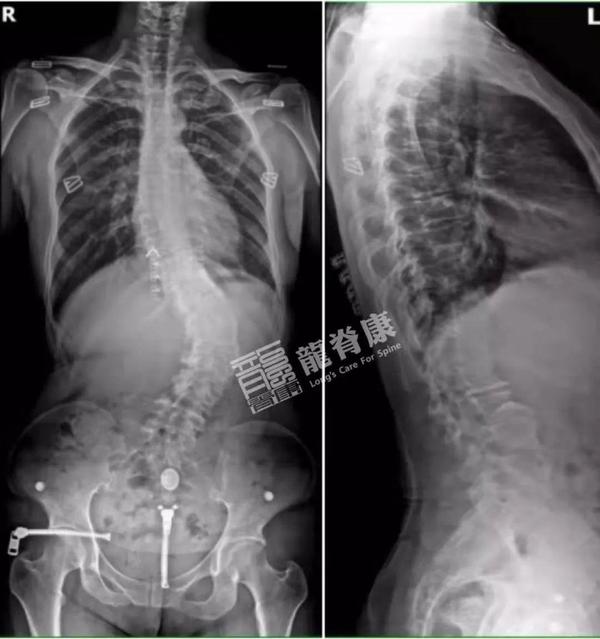 先天性与特发性脊柱侧弯该如何鉴别诊断? - 知乎