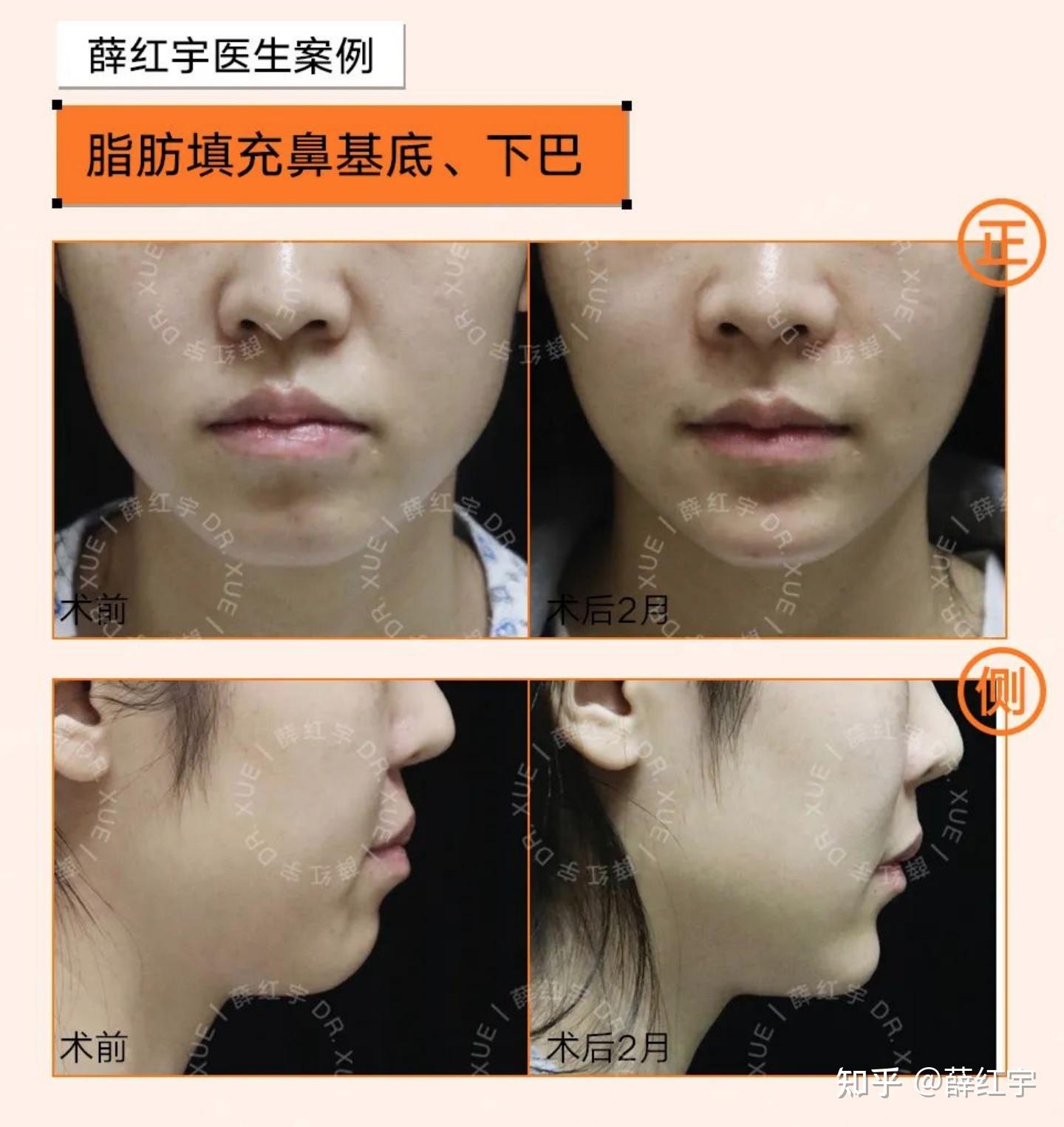 鼻基底凹陷矫治案例分享