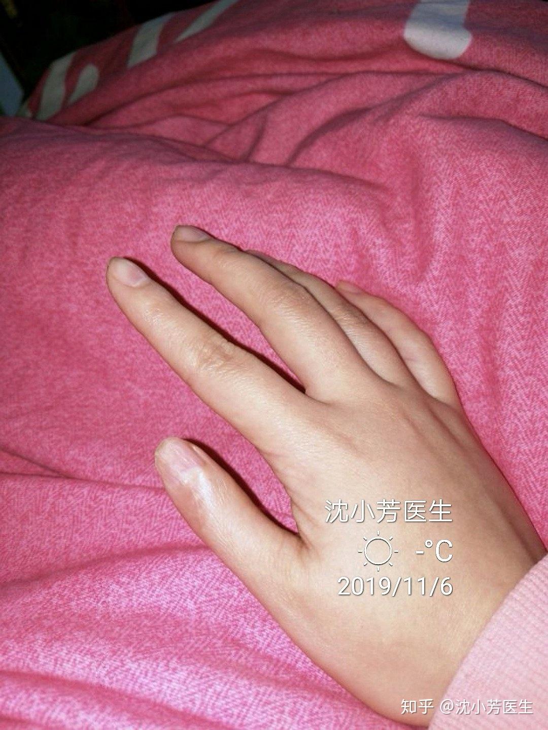 男孩手部先天性畸形，上海医生帮他“食指变拇指”_浦江头条_澎湃新闻-The Paper
