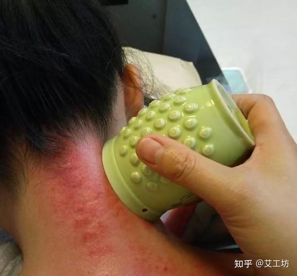 刮痧