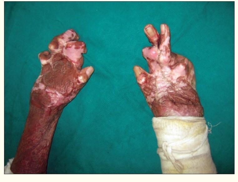 如果错过进行压力治疗黄金期严重烧伤后手一定会出现畸