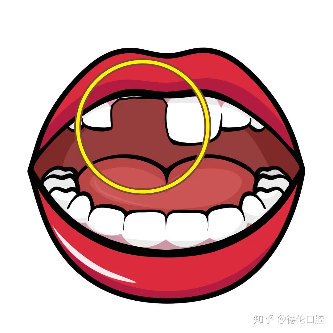 牙外伤紧急处理与后续应对,看完这篇全知道! - 知乎