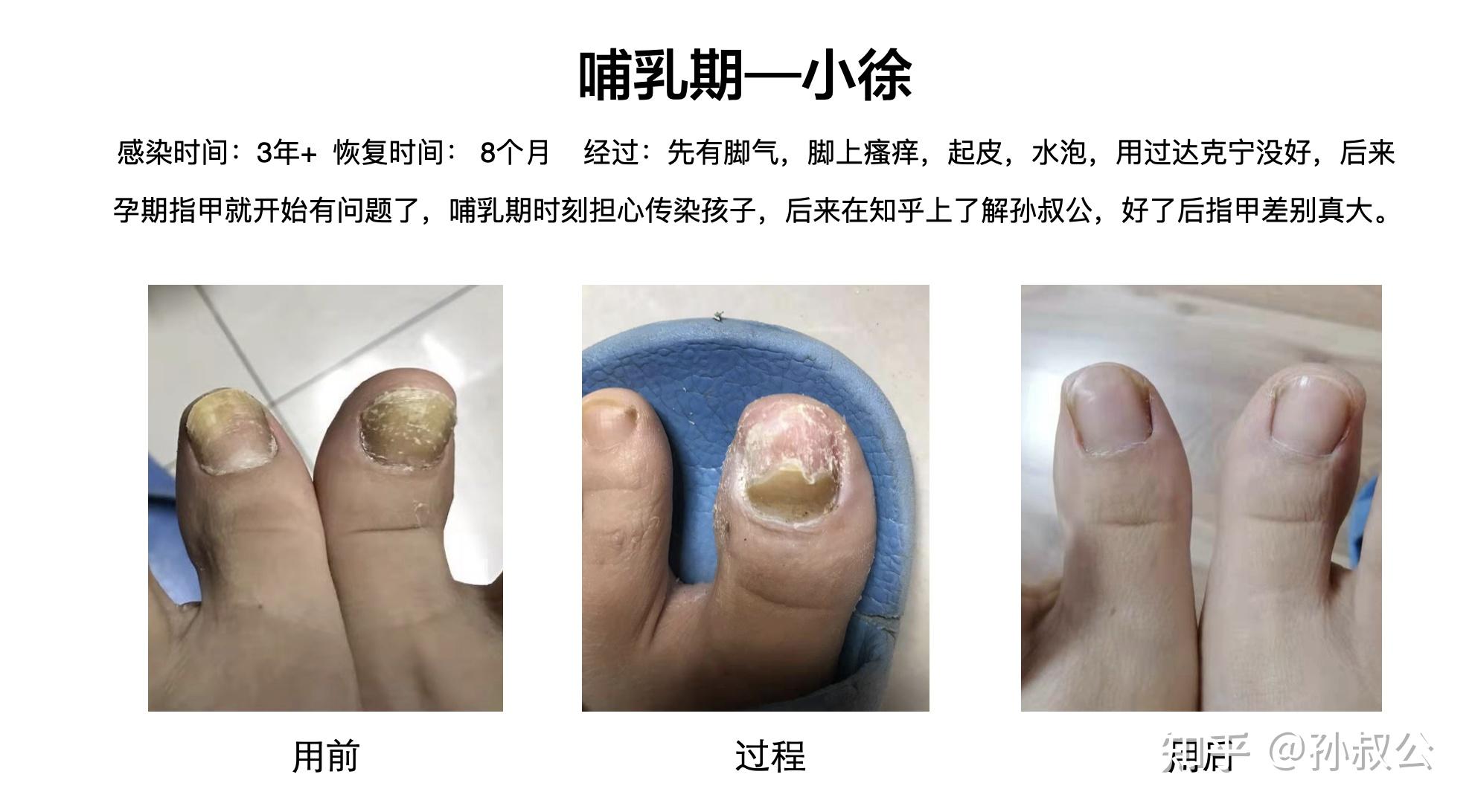 如何正确认识和治疗脚气、灰指甲？