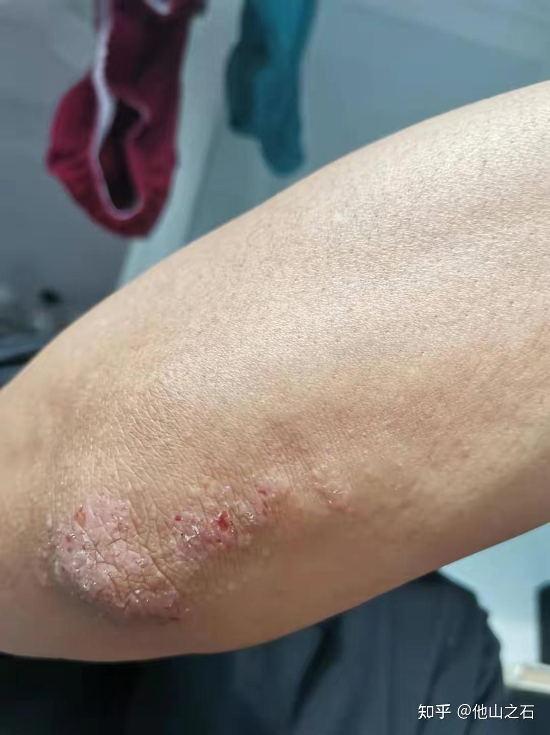 荨麻疹湿疹神经性皮炎傻傻分不清