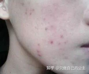 黑色痘印和红色痘印的区别是什么？分别应该怎么去除？ - 知乎