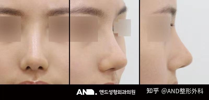 通过鼻唇角矫正实现凸嘴改善的方法 [鼻梁+鼻尖+人中鼻手术] - 知乎