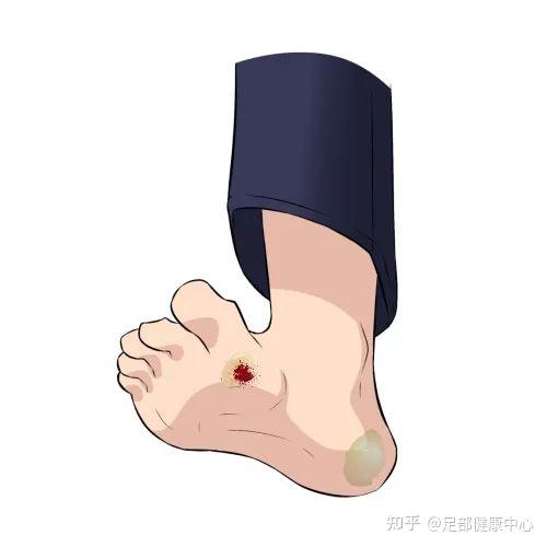 我长的是老茧,和糖尿病足有什么关系?