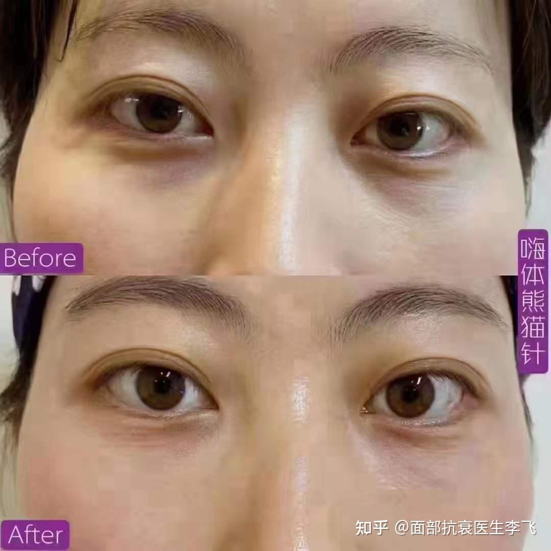 关于嗨提熊猫针你了解多少呢下面我们就来看下吧