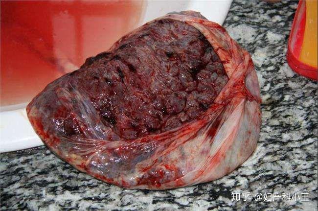 女人生完孩子后胎盘怎样处理