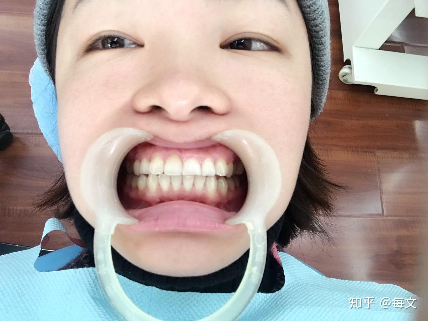 36岁箍牙正畸记录贴10月7日摘牙套咯70