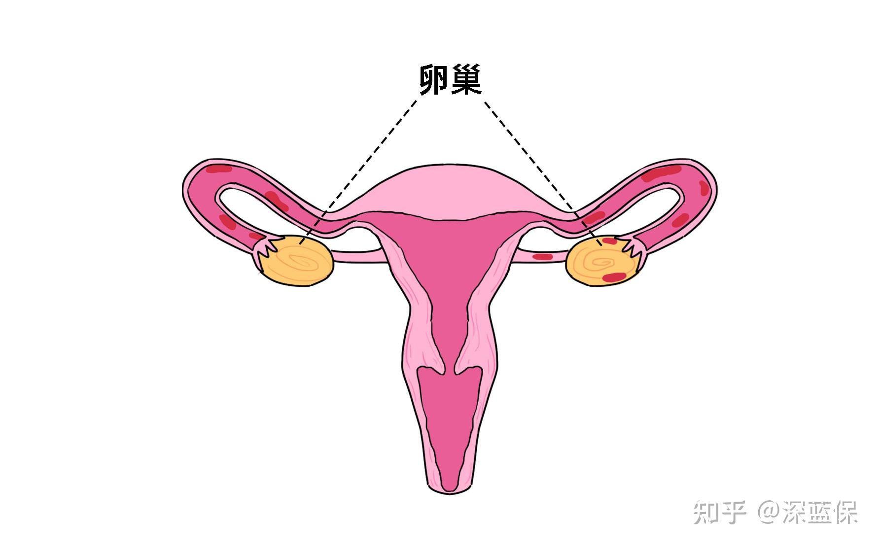 卵巢囊肿怎么买保险?最宽松的产品都汇总在这儿了