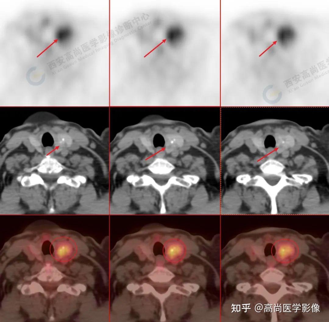 18F- FDG PET/CT检查“无意中”发现的甲状腺癌4例【高尚医学影像】 - 知乎