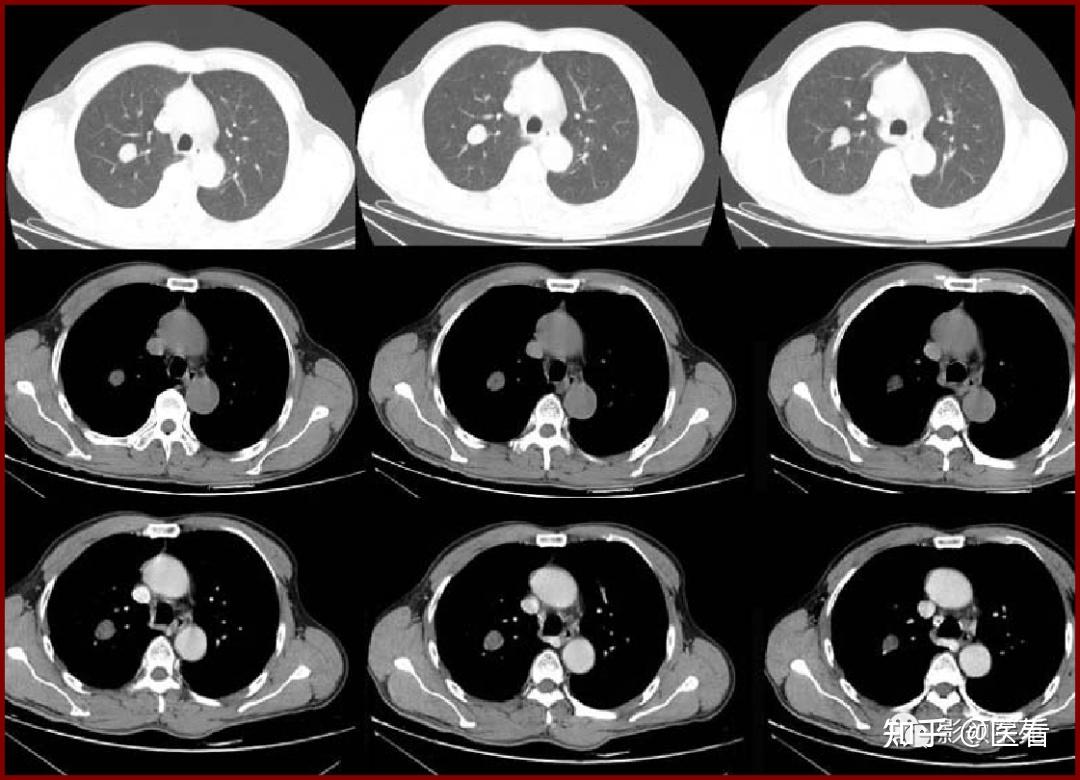 肺良性肿瘤影像表现
