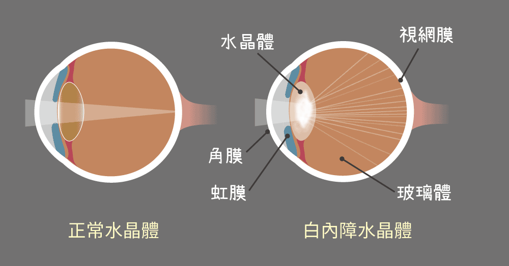 白內障成因先兆症狀治療保險保障全面瞭解