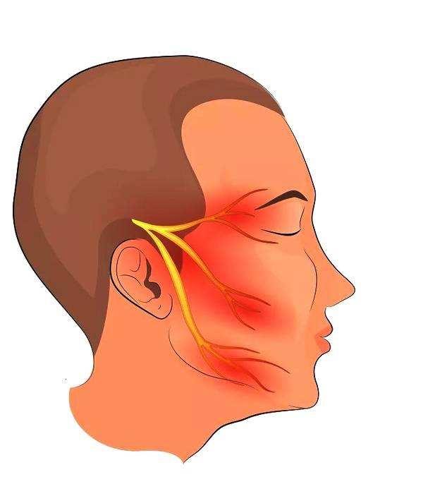 诊前须知三叉神经痛发病特点有规律可循