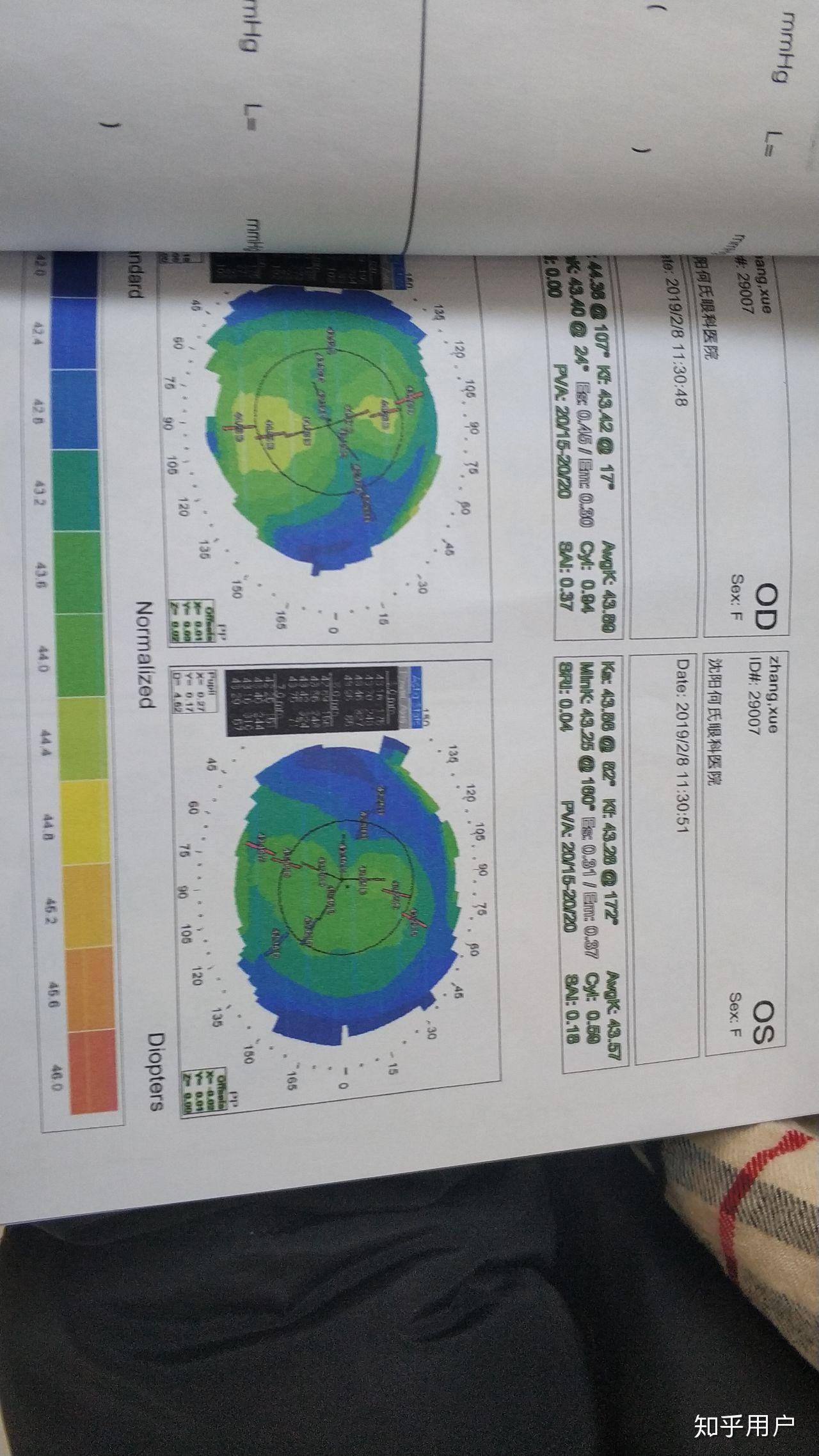 请大神看一下角膜地形图是不是不规则散光晚上看东西上下重影