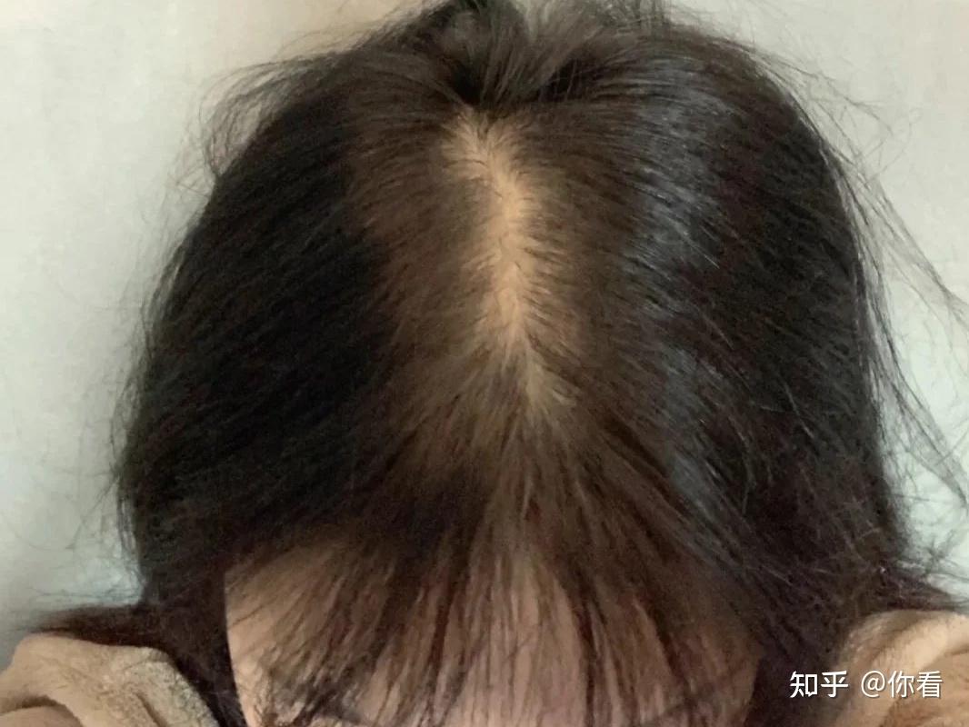 如何让自己的发量变多,头发变得浓密??! - 知乎