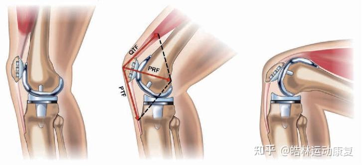 3.股四头肌能控制髌骨运动,可使其沿正确的力线运动.