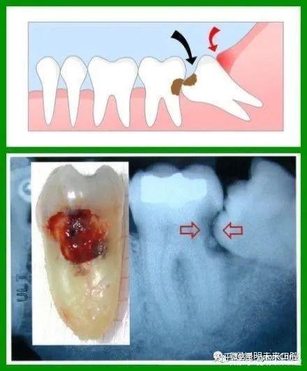 智齿的牙根有多长图片图片