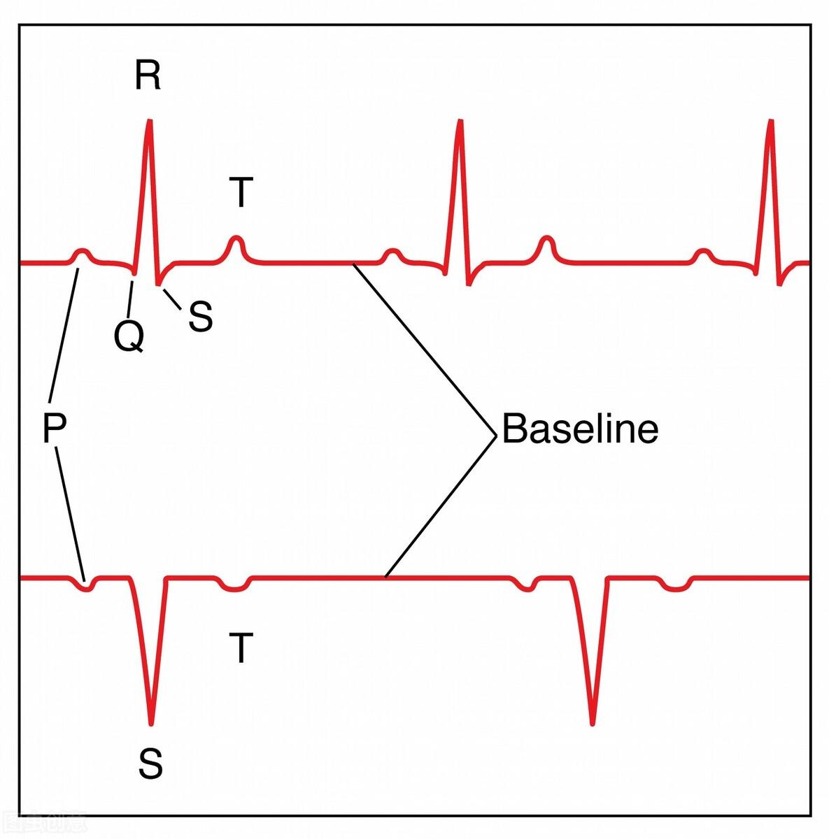心电图st波倒置的图像图片