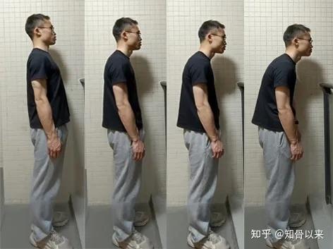 含胸驼背,用"背背佳"真的管用吗?