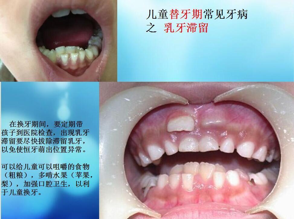 相应的乳牙还没有脱落,赶紧去牙科拔掉滞留的乳牙!