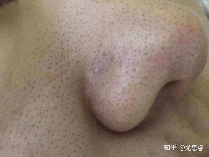 啥是黑头 v2-81090697f83136d33461c04d67225f8d_r.jpg