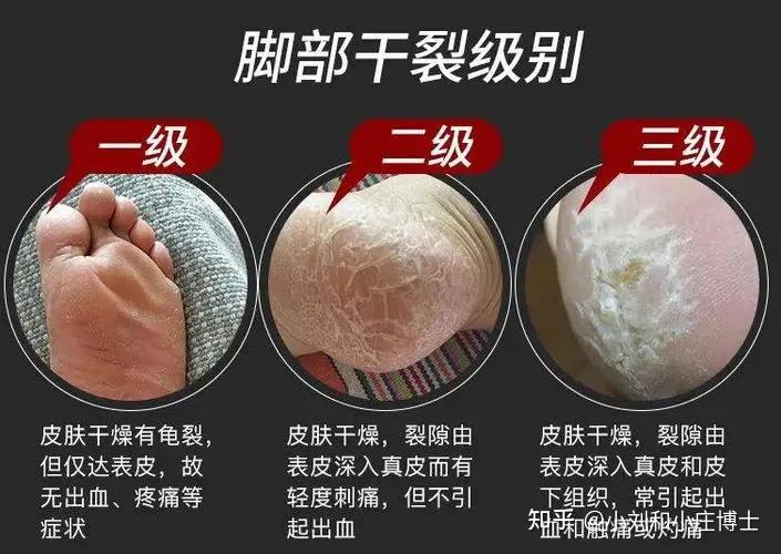 缺少水分缺少水分是导致脚后跟干裂起皮的最常见原因.
