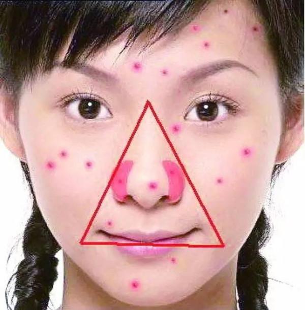 鼻头长痘的治疗方法 知乎 鼻头长痘的治疗方法 知乎