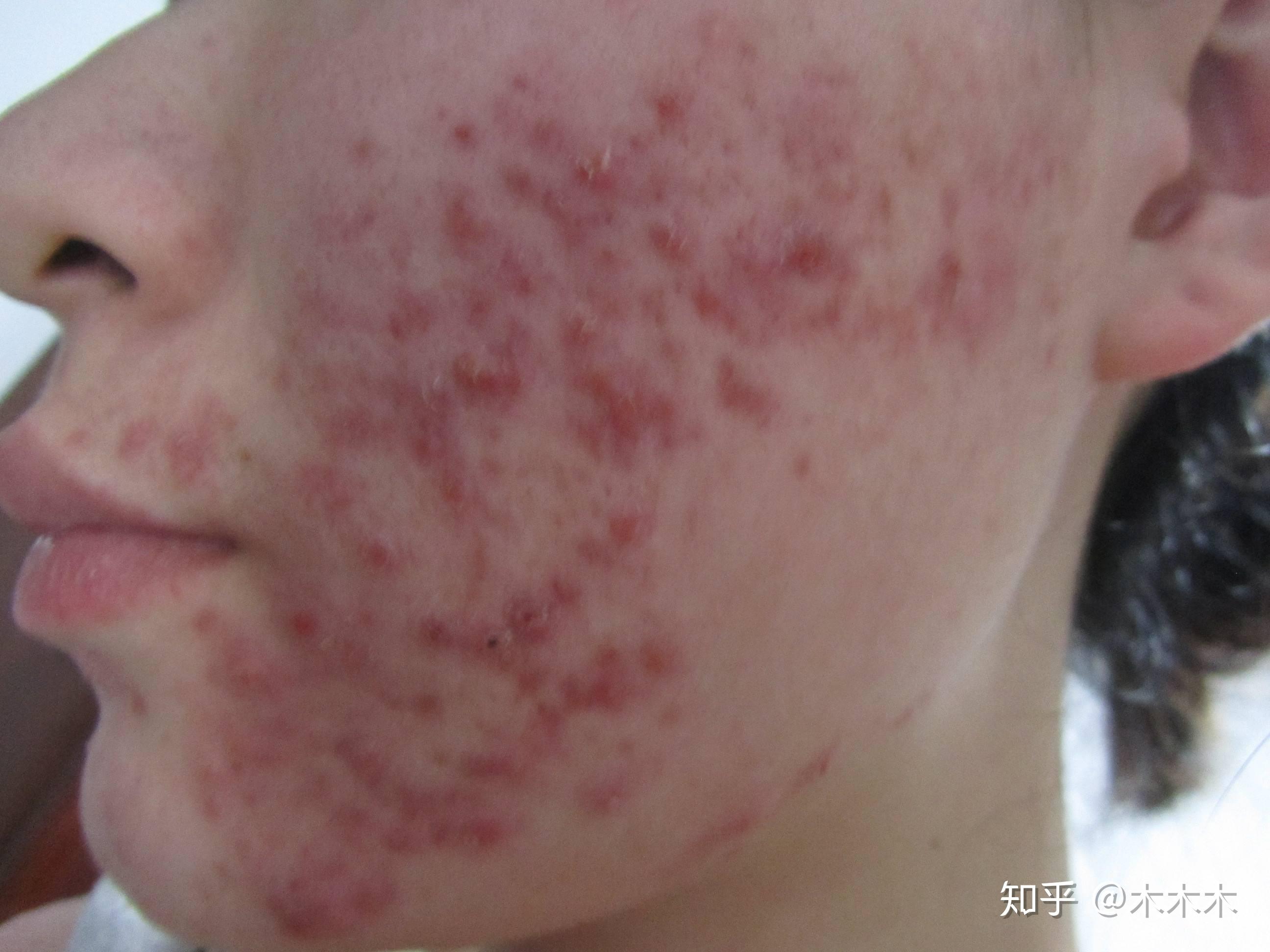 痤疮痘痘治疗