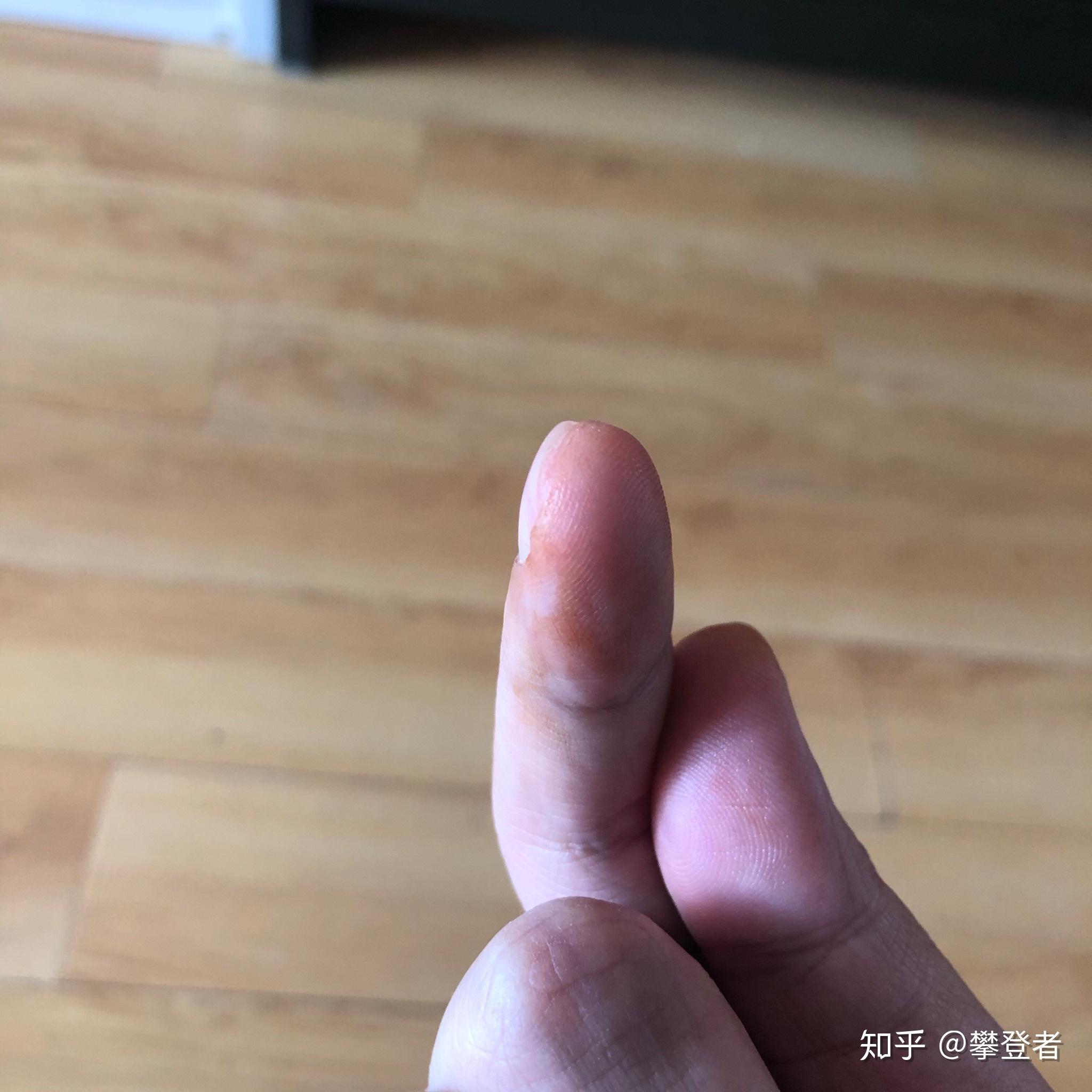 睡醒手上有铁锈色而且洗不掉
