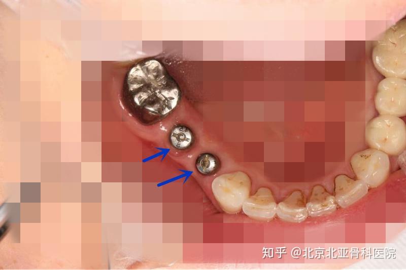 种植体(人工牙根)愈合过程中去除愈合基台,见良好的龈袖口安放修复