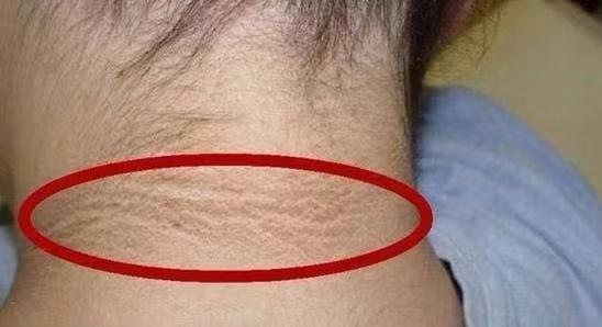 胖人脖子一圈黑泥垢洗不掉他不是不讲卫生是快得糖尿病啦