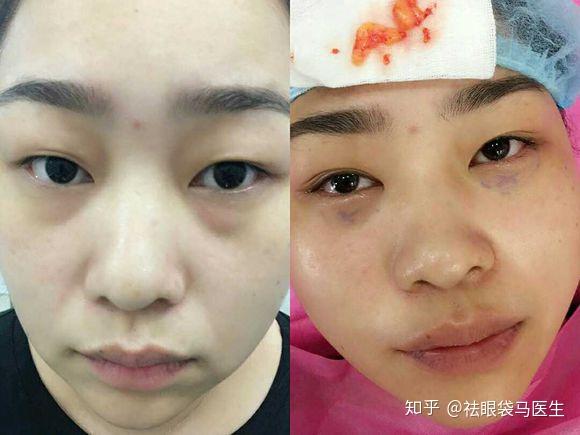祛眼袋马医生4a青春定制祛眼袋眼底脂肪