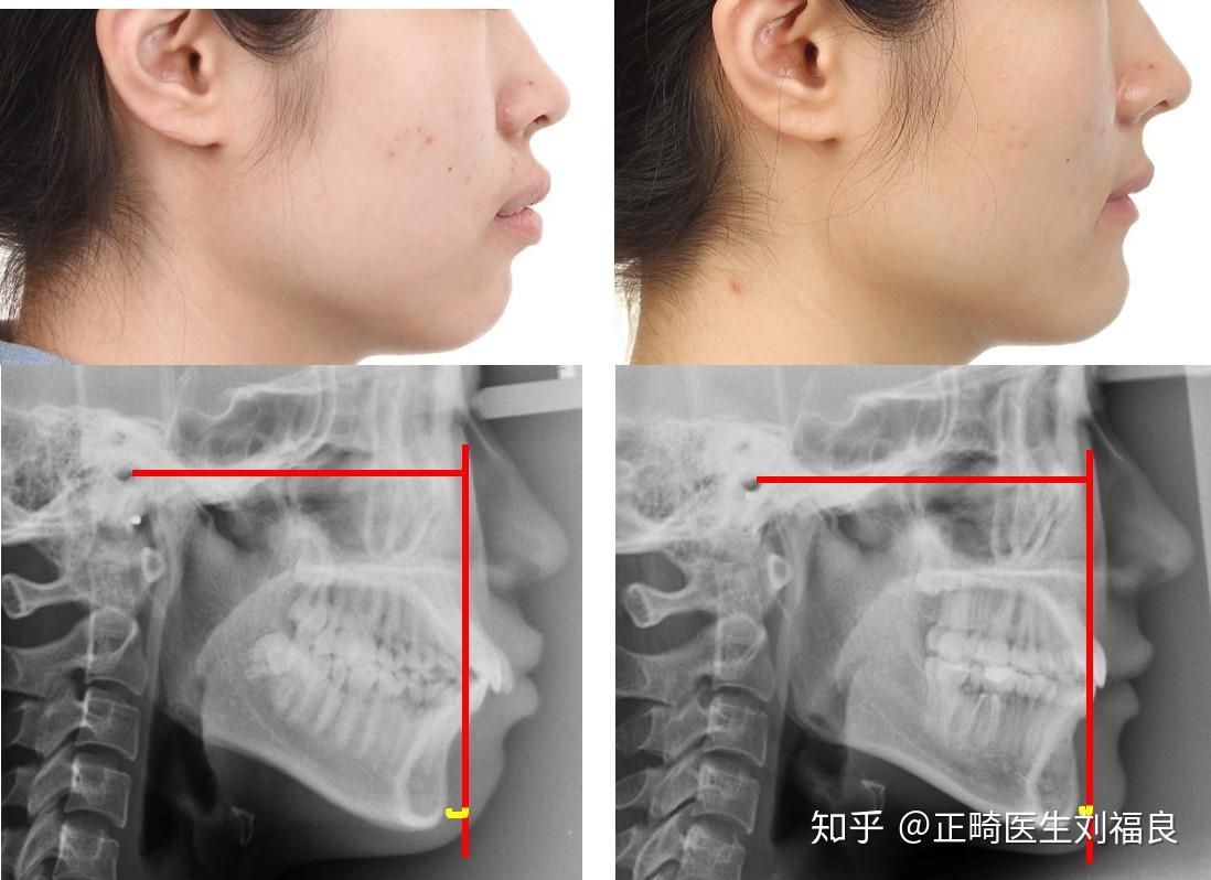 三,还有介于两种类型之间,既有骨性下颌后缩的成分,又有牙突的成分