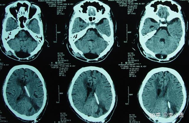 小腦扁桃體下疝脊髓空洞枕下減壓術後假性腦膜膨出腦積水手術治療失敗