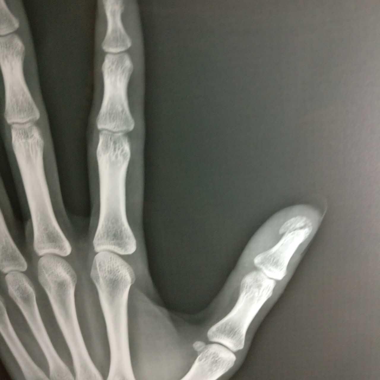 《手和手腕的功能解剖》腕骨小关节复位法视频_新视网