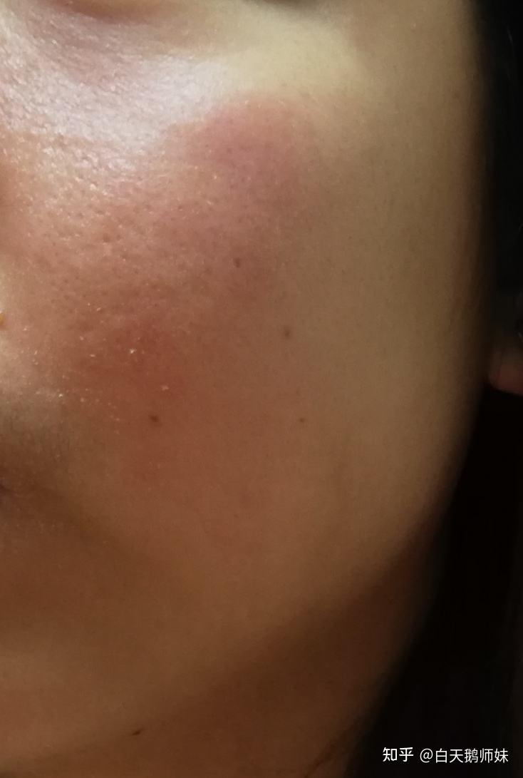 如果刷酸了几天以后出现脱皮泛红干燥的情况,说明这个酸对你的刺激性