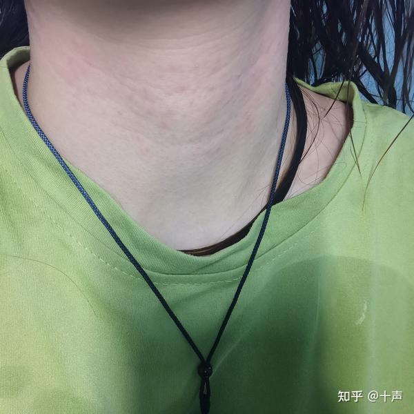 脖子下面发红不痒 艾滋病初期脖子痒图片 脖子上红了一片海洋