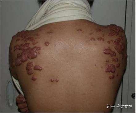 有一种难以承受的痛叫"疤痕疙瘩"