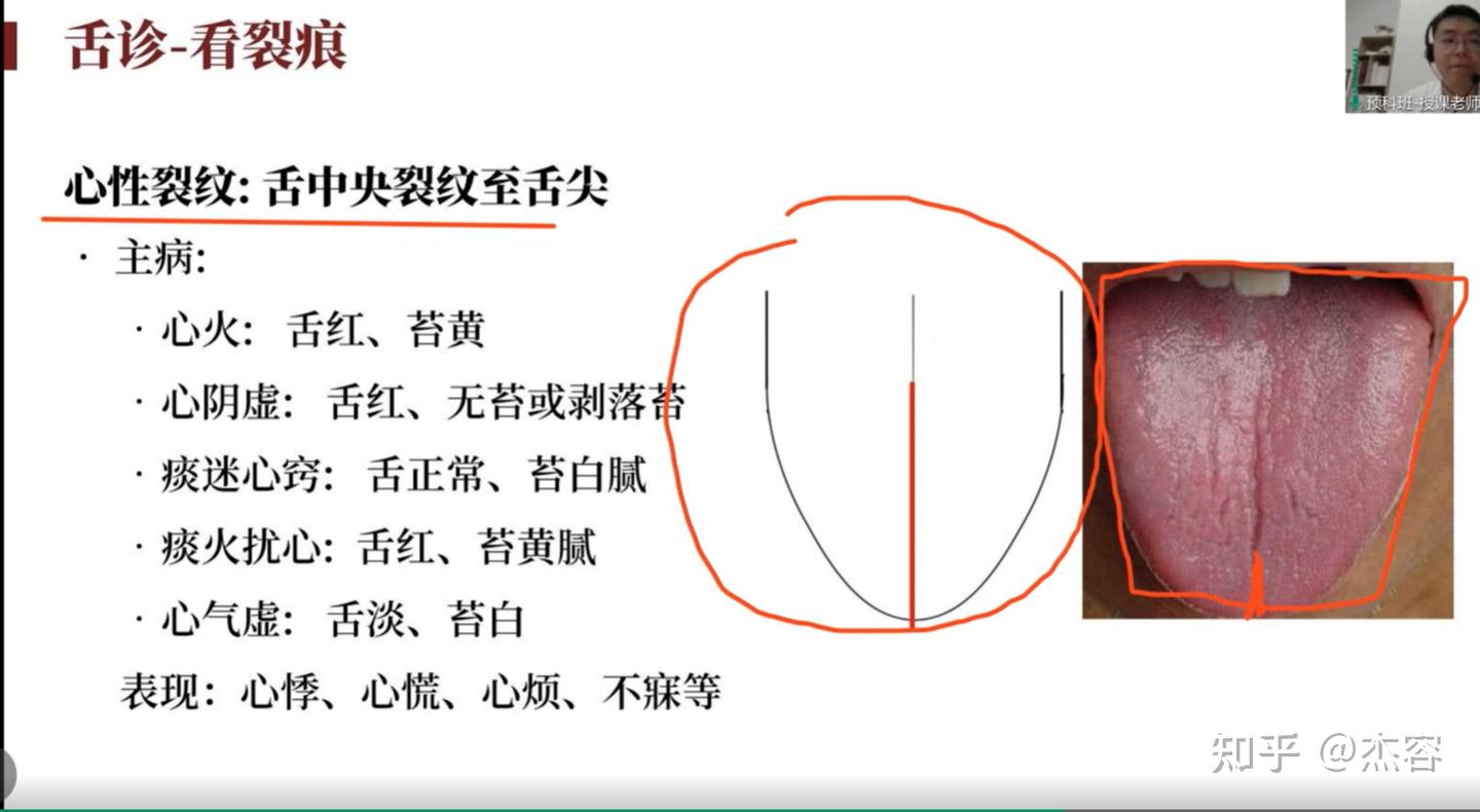 中医学习笔记5:舌诊 - 知乎