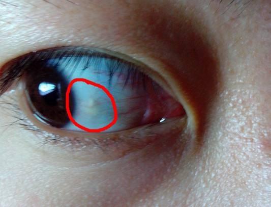 致盲的那叫黄斑病变,而不是眼球上的黄色斑点!