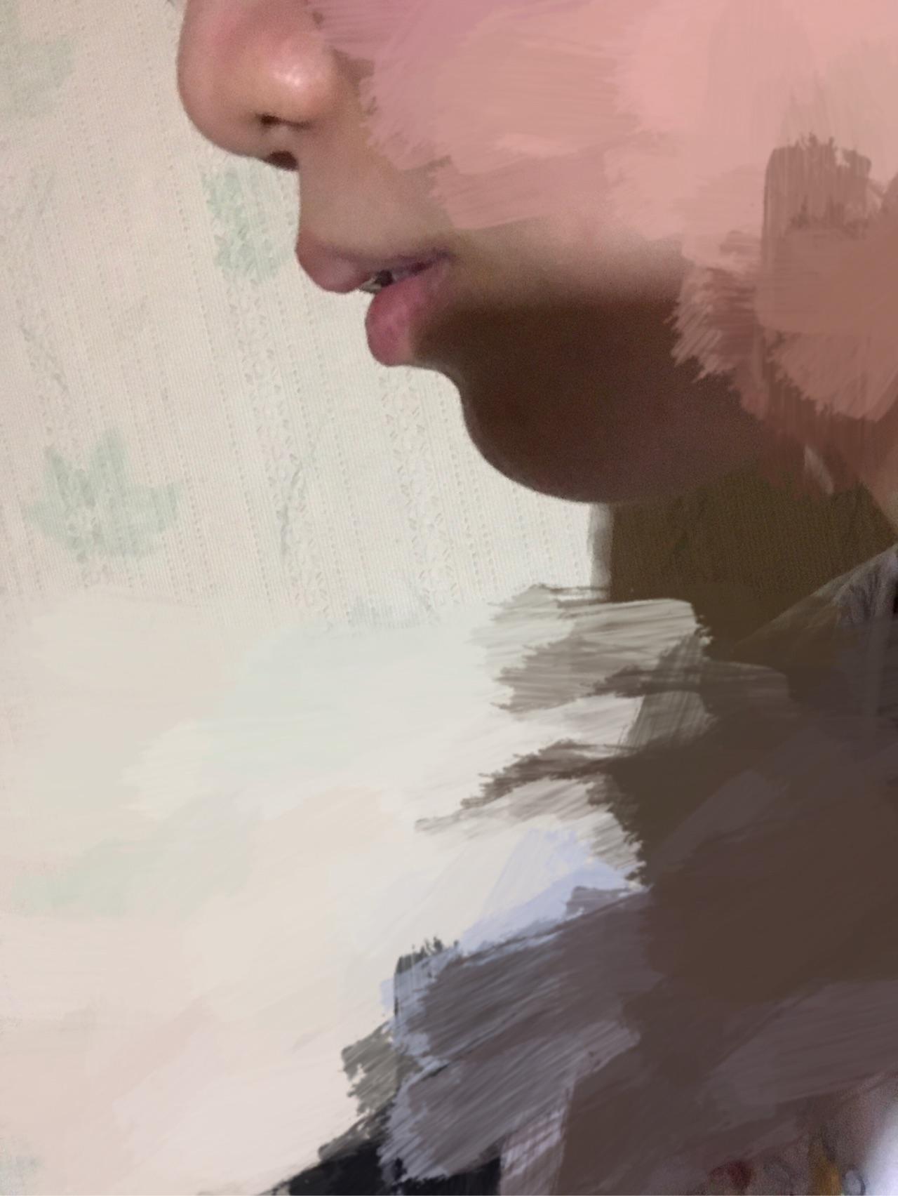 大家帮我看下我的嘴凸吗?需要如何治疗? - 牙齿