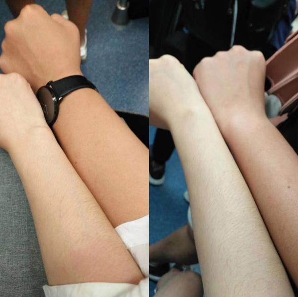 最后,附上我手臂的变色图