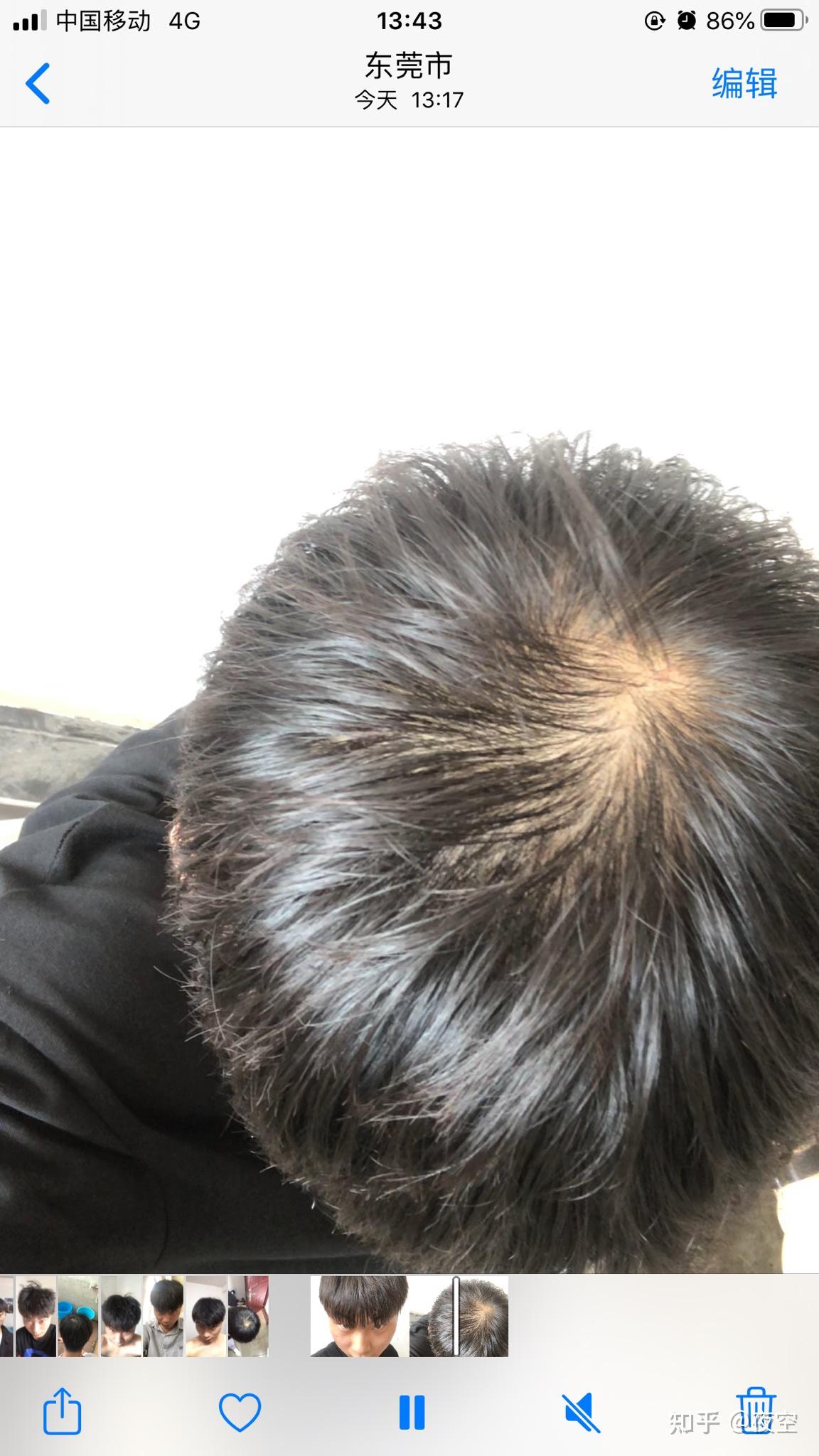 男生头顶掉头发