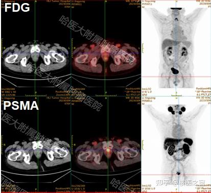 【专家解说】王可铮：“精确制导”PET/CT—18F-PSMA-1007特异性分子探针助力前列腺癌精准诊疗！ - 知乎