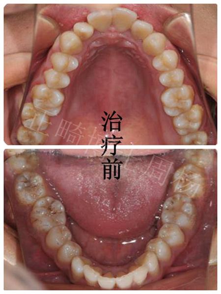 什么是快速扩弓器扩弓矫治初体验