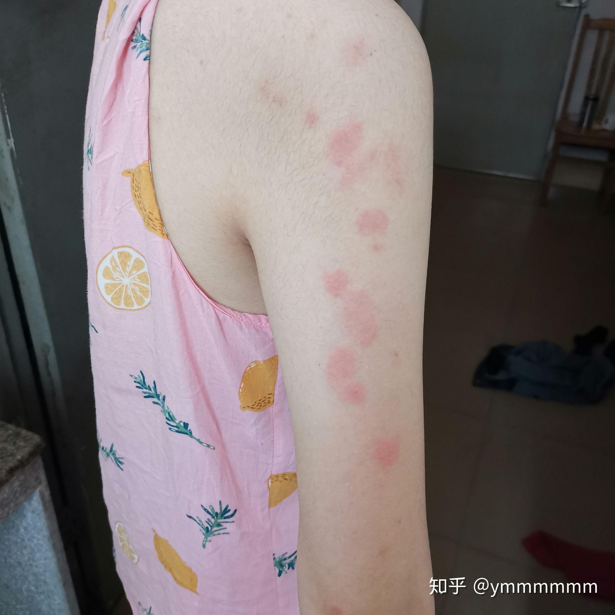 虫咬性荨麻疹一个多月还没好,怎么根治?